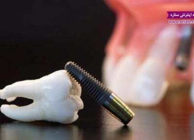 ایمپلنت دندان؛ همه چیز درباره جایگزینی و کاشت دندان